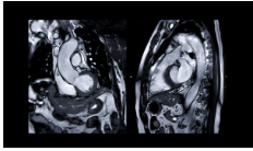 Cardiac MRI Image